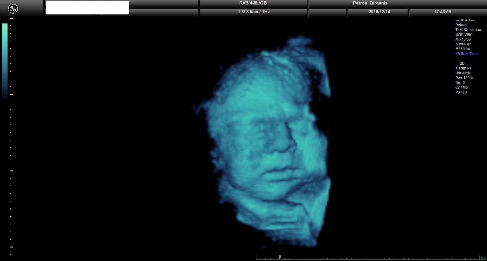Εμβρυο 36 Εβδομάδων Προγεννητική Υπερηχογραφία 3D 2