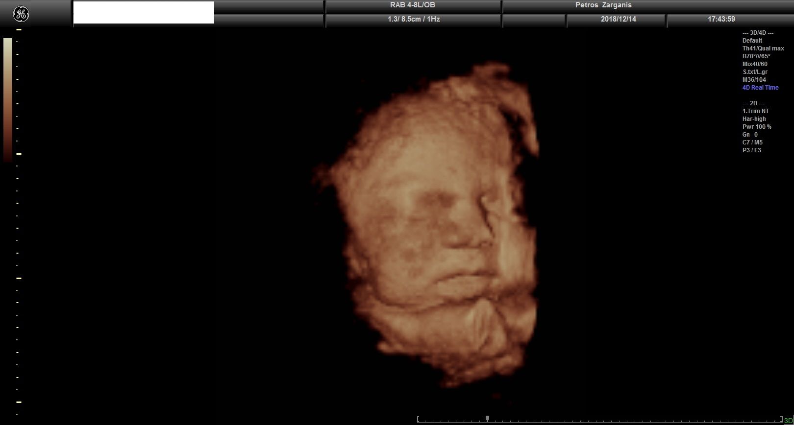 Εμβρυο 36 Εβδομάδων Προγεννητική Υπερηχογραφία 3D 3