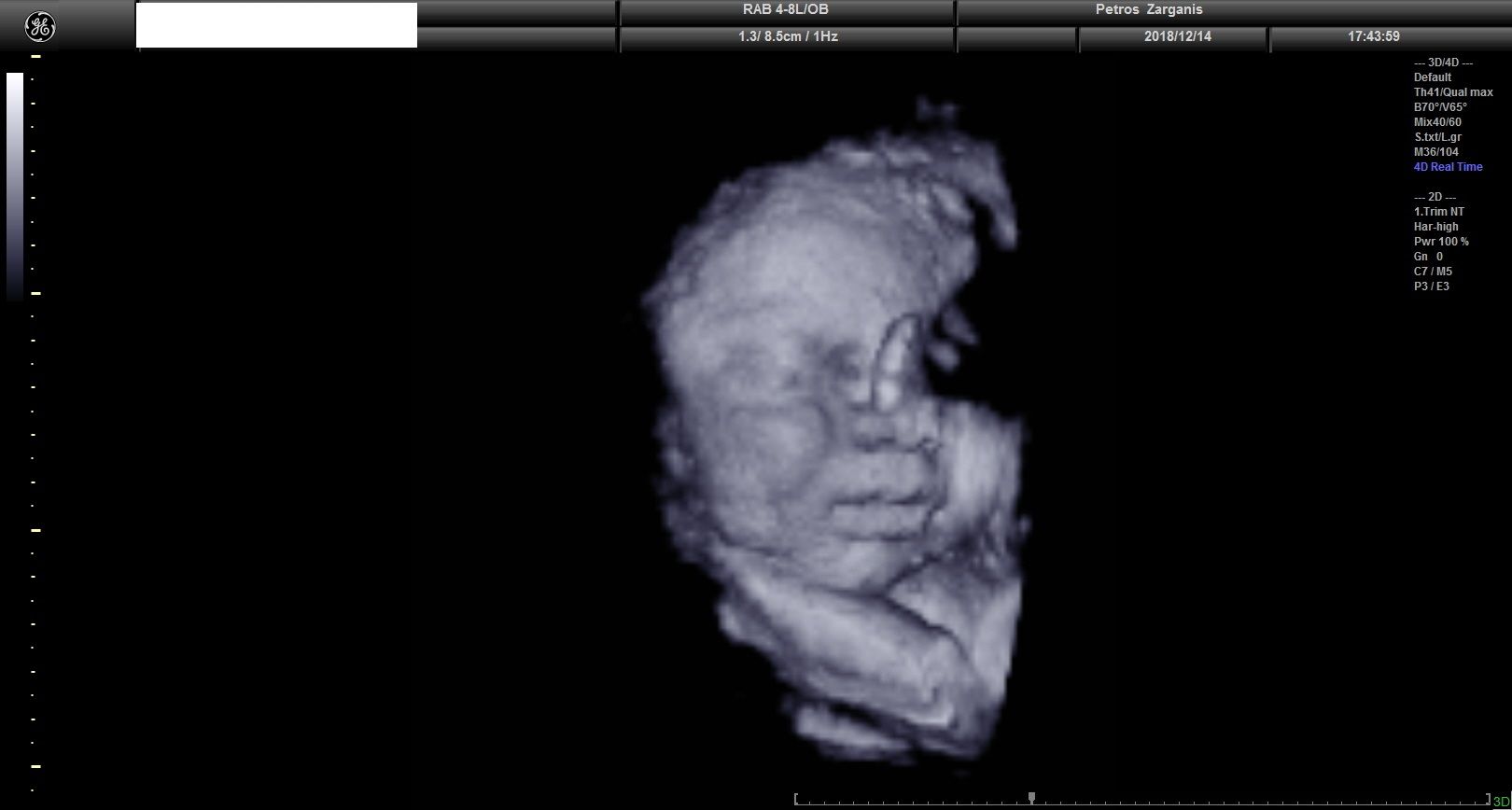 Εμβρυο 36 Εβδομάδων Προγεννητική Υπερηχογραφία 3D 4