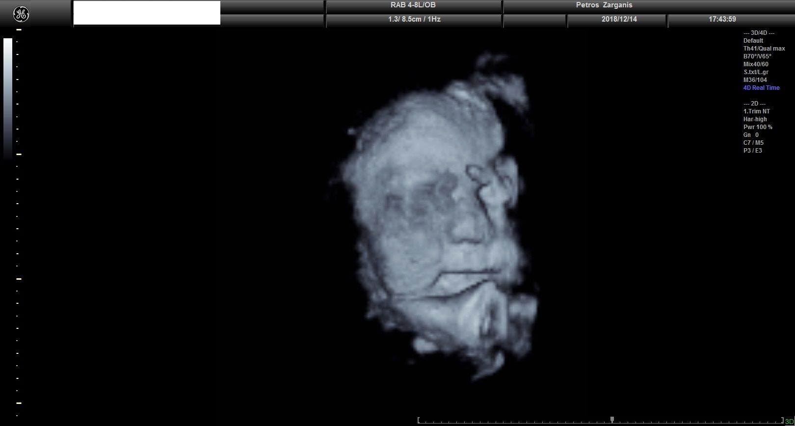 Εμβρυο 36 Εβδομάδων Προγεννητική Υπερηχογραφία 3D 5