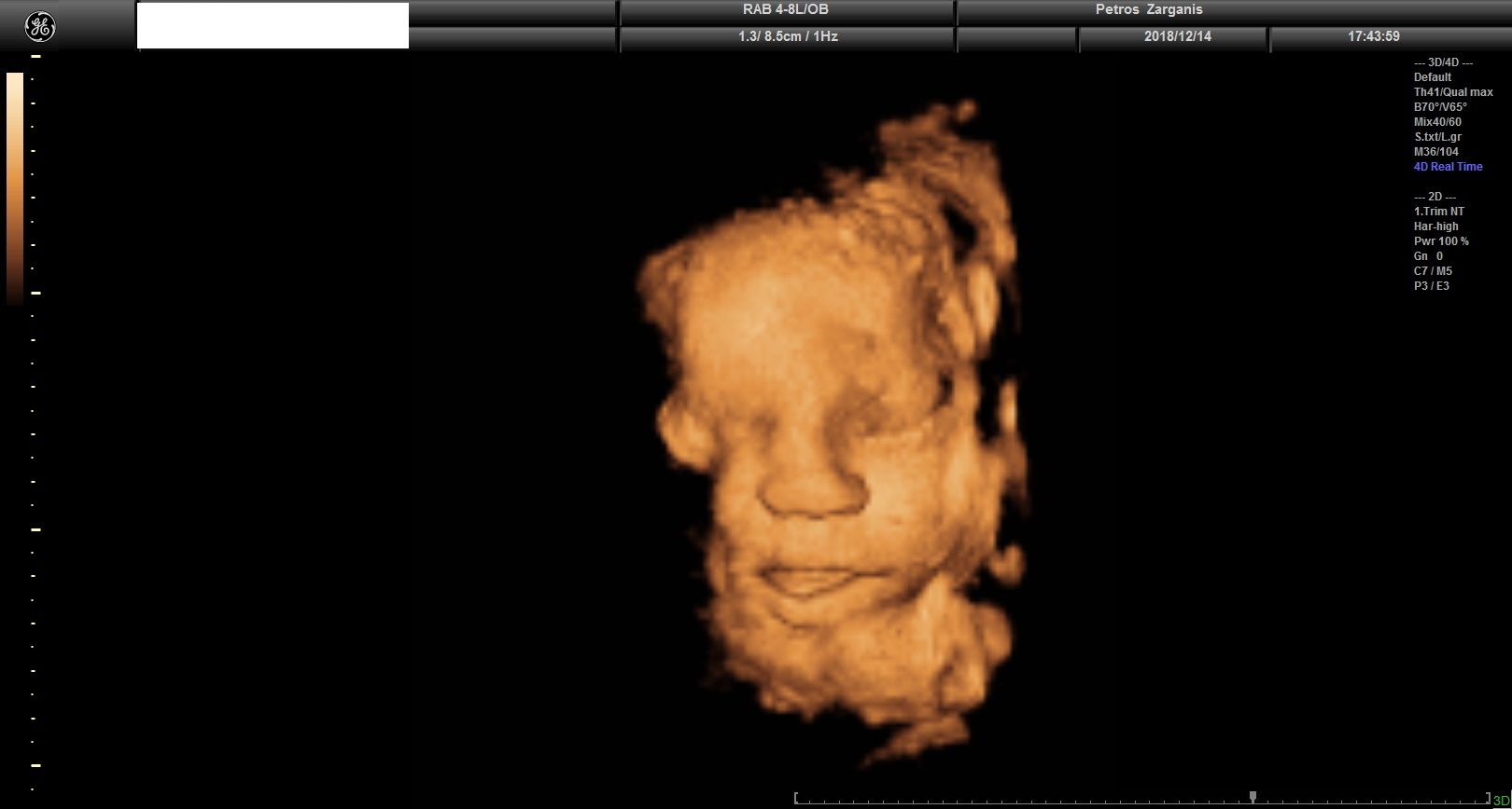Εμβρυο 36 Εβδομάδων Προγεννητική Υπερηχογραφία 3D 6