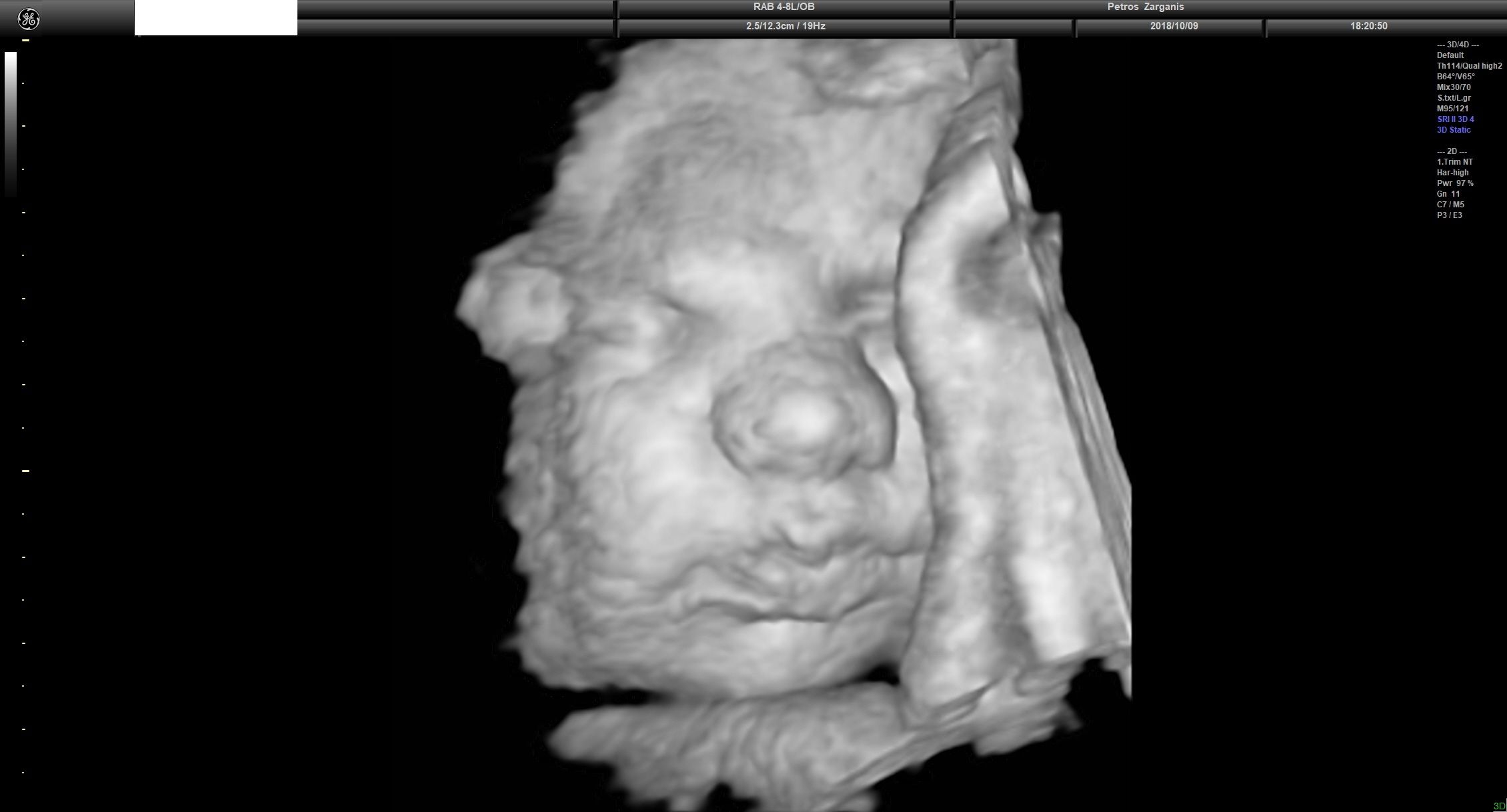 Εμβρυο 36 Εβδομάδων Προγεννητική Υπερηχογραφία 3D 10