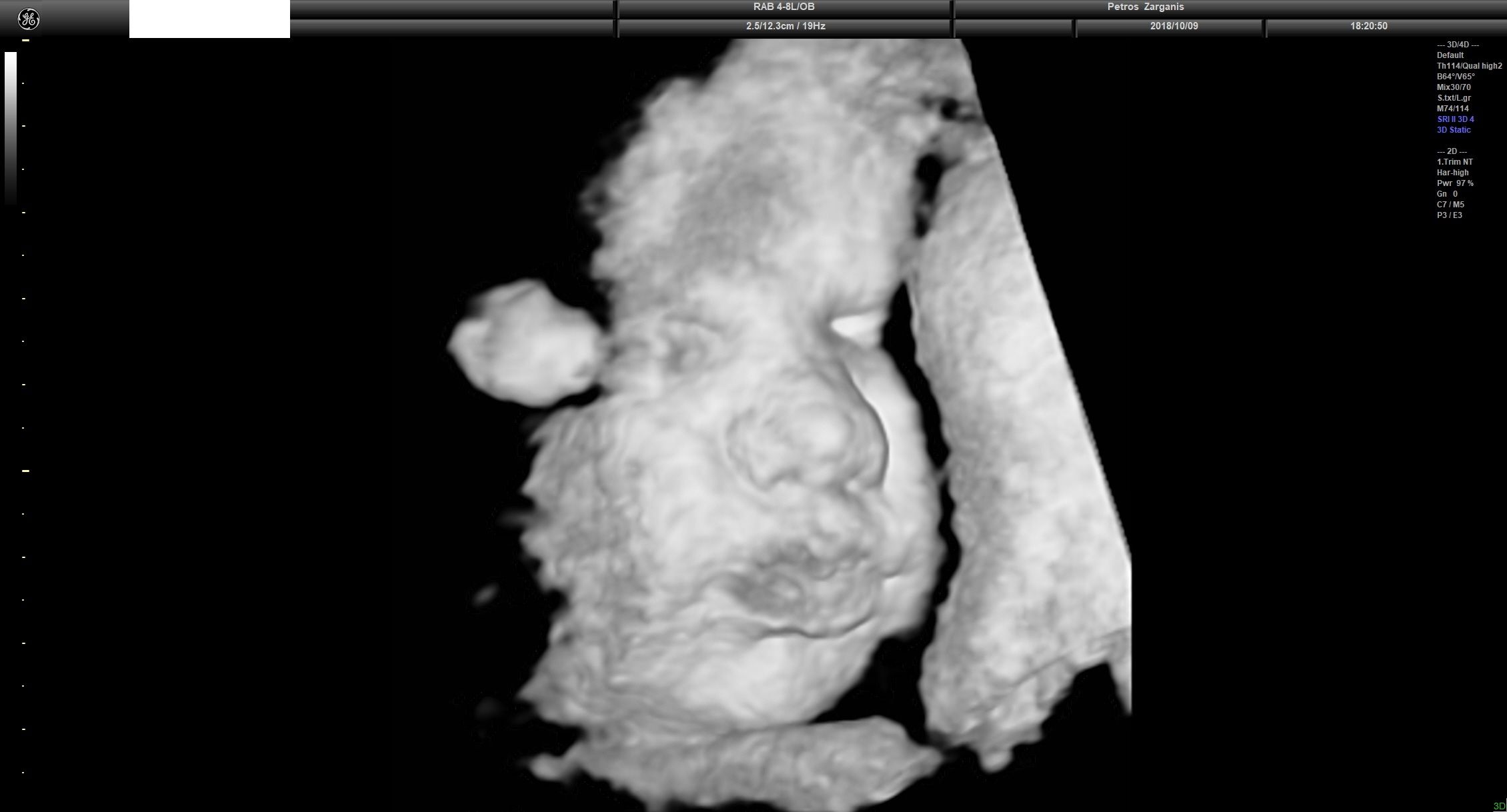 Εμβρυο 36 Εβδομάδων Προγεννητική Υπερηχογραφία 3D 11