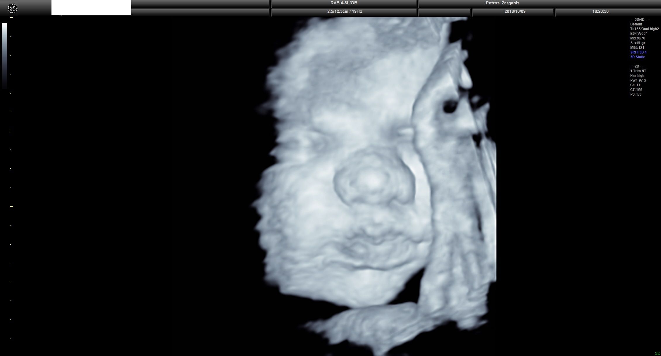 Εμβρυο 36 Εβδομάδων Προγεννητική Υπερηχογραφία 3D 16