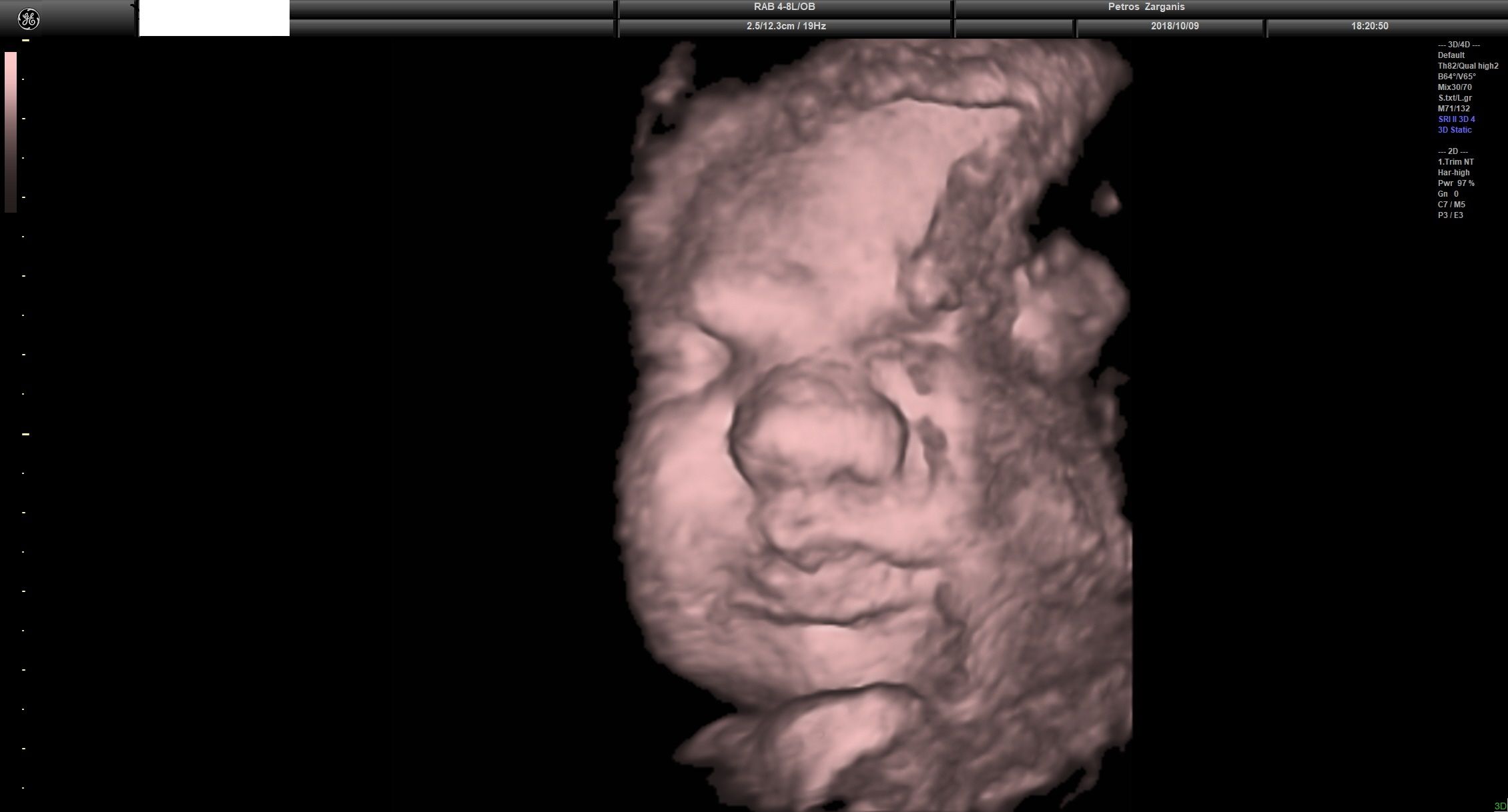Εμβρυο 36 Εβδομάδων Προγεννητική Υπερηχογραφία 3D 17