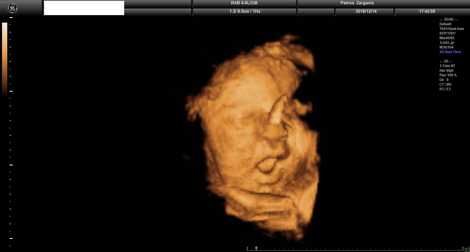 Εμβρυο 36 Εβδομάδων Προγεννητική Υπερηχογραφία 3D 1