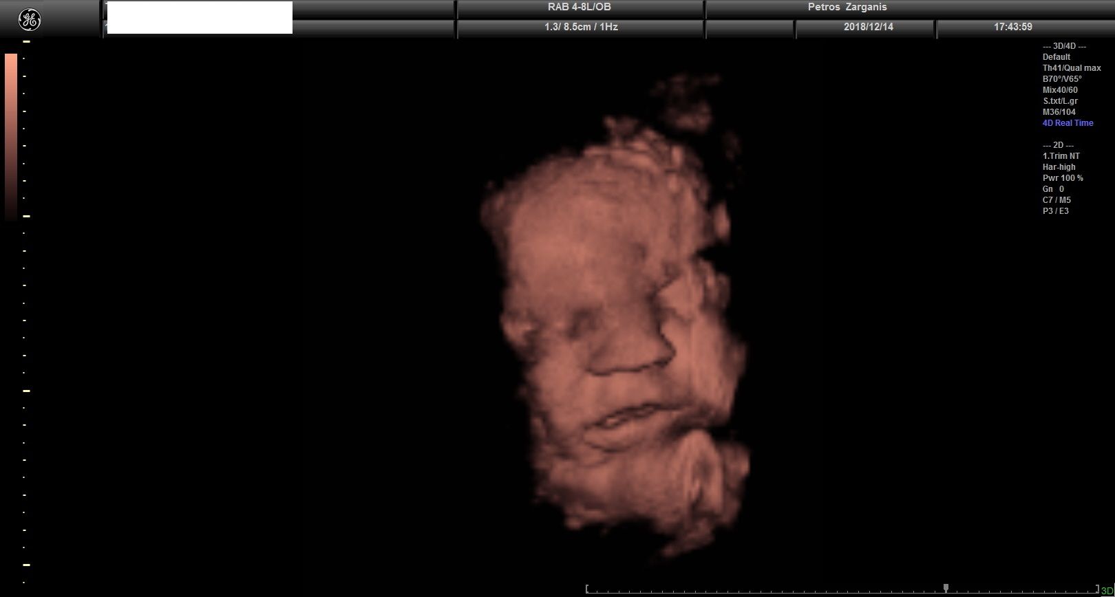 Εγκυμοσυνη 36 Εβδομάδων Προγεννητική Υπερηχογραφία 3D 7