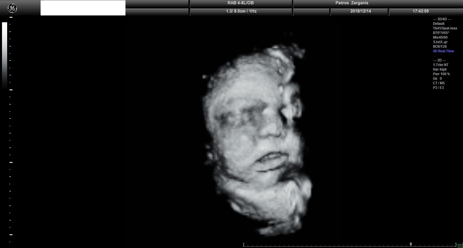 Εμβρυο 36 Εβδομάδων Προγεννητική Υπερηχογραφία 3D 9