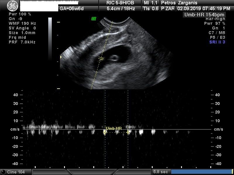 Εμβρυο 6 εβδομάδων και 6 ημερών , καρδιακός παλμός [11]