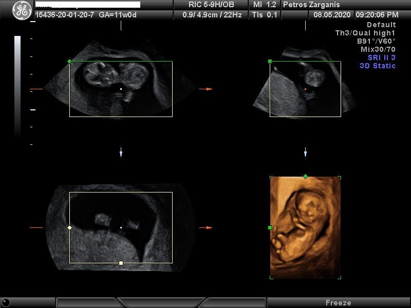 Εμβρυο 11 εβδομάδων +1 ημερών τρισδιάστατη απεικόνιση , σε εγκυμοσύνη με κυστικό (άρρηκτο ωοθυλάκιο)και ευχάριστη εξέλιξη  [1]