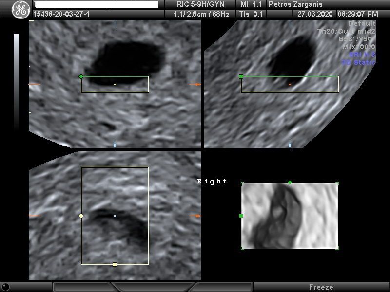 Εμβρυο 4 εβδομάδων +1 ημερών τρισδιάστατη απεικόνιση , σε εγκυμοσύνη με κυστικό (άρρηκτο ωοθυλάκιο)και ευχάριστη εξέλιξη  [1]