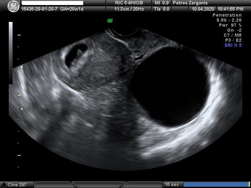 Εμβρυο 7 εβδομάδων +1 ημερών τρισδιάστατη απεικόνιση , σε εγκυμοσύνη με κυστικό (άρρηκτο ωοθυλάκιο)και ευχάριστη εξέλιξη  [1]