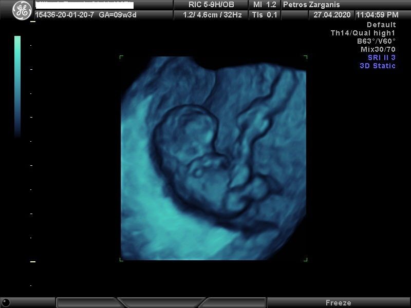 Εμβρυο 9 εβδομάδων +3 ημερών τρισδιάστατη απεικόνιση , σε εγκυμοσύνη με κυστικό (άρρηκτο ωοθυλάκιο)και ευχάριστη εξέλιξη  [1]