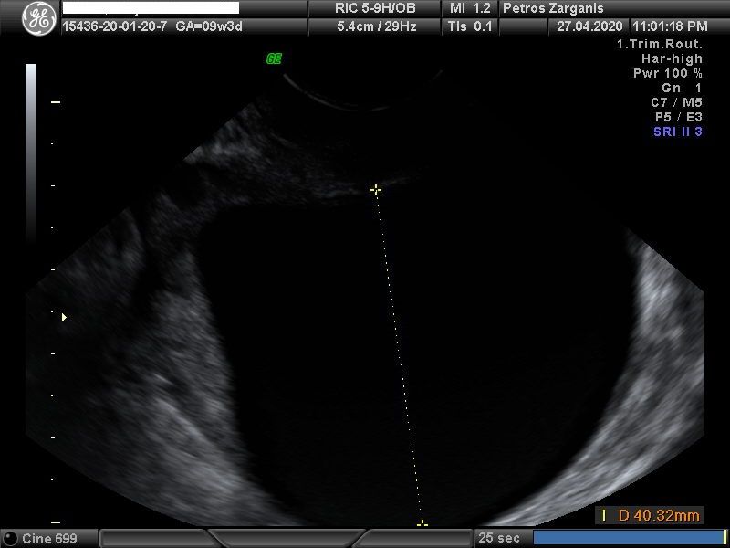 Εμβρυο 9 εβδομάδων +3 ημερών τρισδιάστατη απεικόνιση , σε εγκυμοσύνη με κυστικό (άρρηκτο ωοθυλάκιο)και ευχάριστη εξέλιξη  [1]