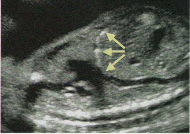 Υποδιαφραγματικές ασβεστώσεις στις 15 εβδομάδες . Το έμβρυο δεν είχε πρόβλημα . 