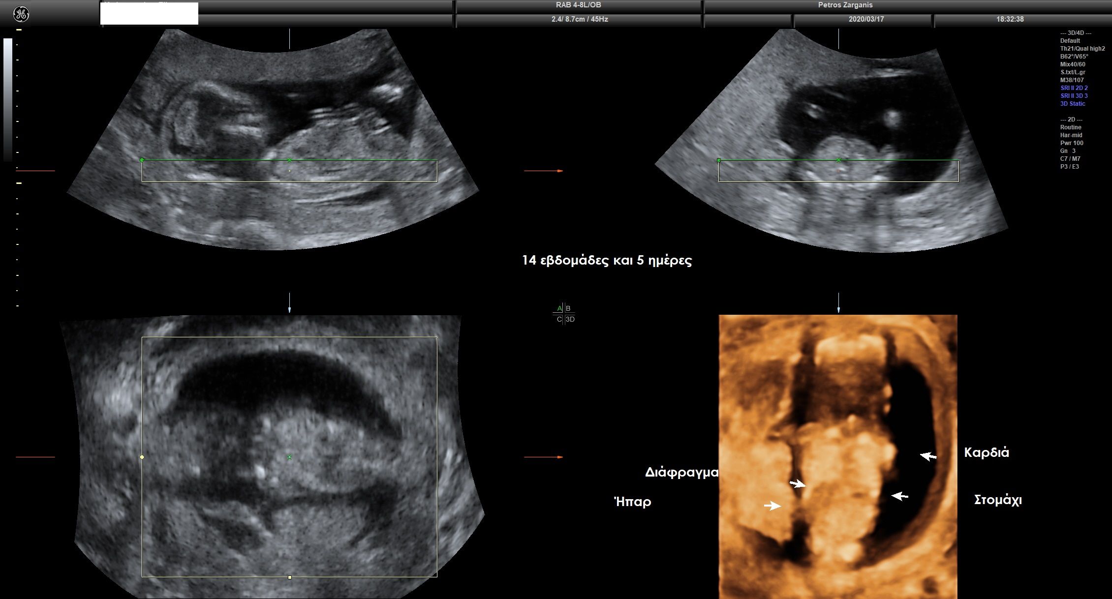 Εμβρυο 14+5 εβδομάδων Στομάχι , καρδιά , ήπαρ , διάφραγμα ,  σε σωστές ανατομικά σχέσεις