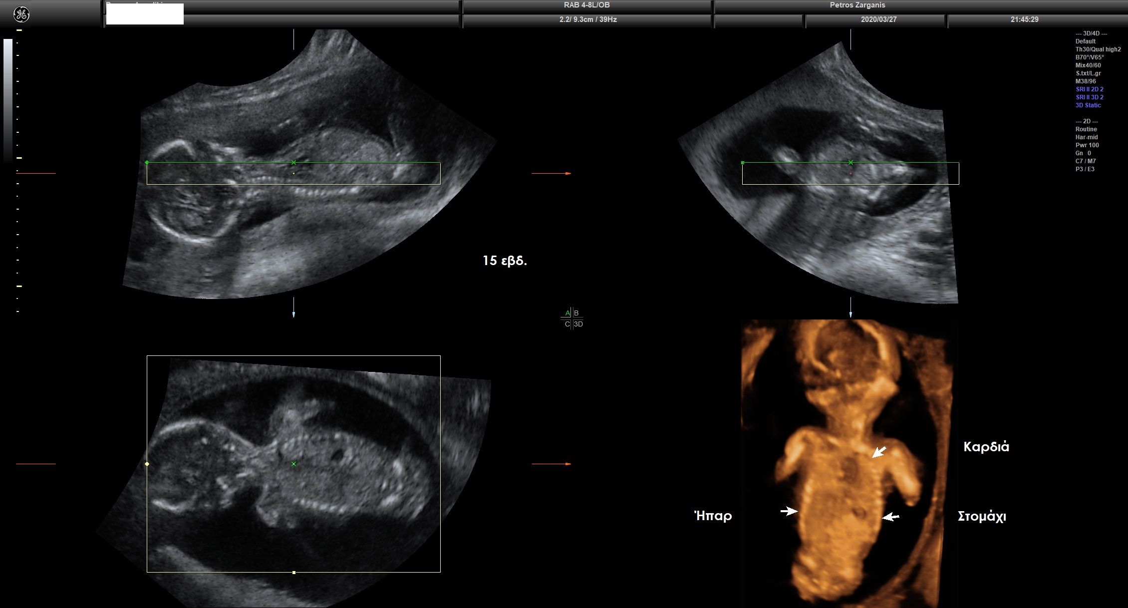 Εμβρυο 15 εβδομάδων Στομάχι , καρδιά , ήπαρ , διάφραγμα ,  σε σωστές ανατομικά σχέσεις