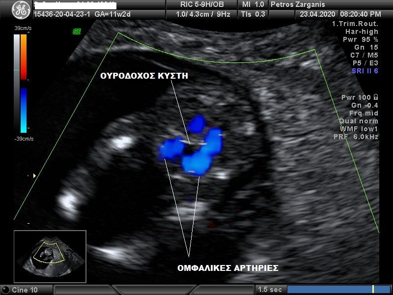 Εμβρυο 11+2 εβδομάδων. Η ουροδόχος κύστη βρίσκεται ανάμεσα στις δύο ομφαλικές αρτηρίες.