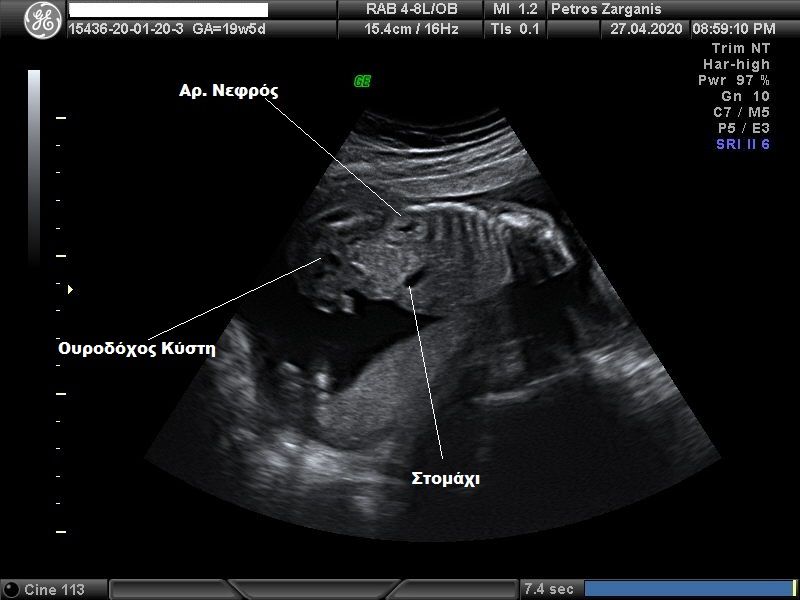 Εμβρυο 19+5 εβδομάδων. Η ουροδόχος κύστη , αρ νεφρός και στομάχι είναι ορατά,  σε σωστές ανατομικά σχέσεις