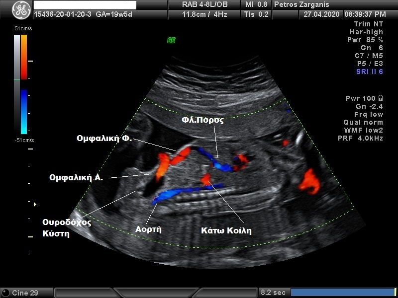 Εμβρυο 19+5 εβδομάδων. Η ουροδόχος κύστη , ομφαλίδα , καρδιά , φλεβώδης πόρος,σε σωστές ανατομικά σχέσεις.