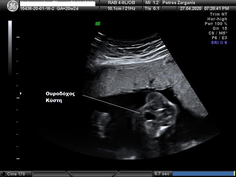 Εμβρυο 20+2 εβδομάδων. Η ουροδόχος κύστη εμφανής.