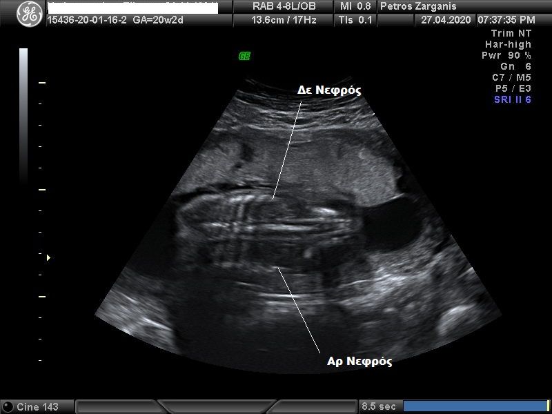 Εμβρυο 20+2 εβδομάδων . Οι νεφροί είναι ορατοί σχετικά εύκολα .