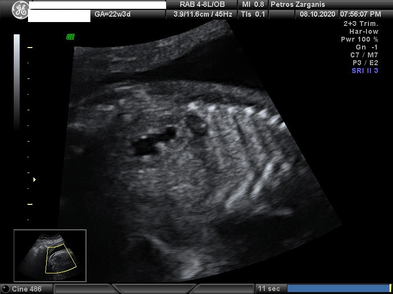Εμβρυο 22+2 εβδομάδων . Εμφανίζεται διάταση στον αριστερό νεφρό .