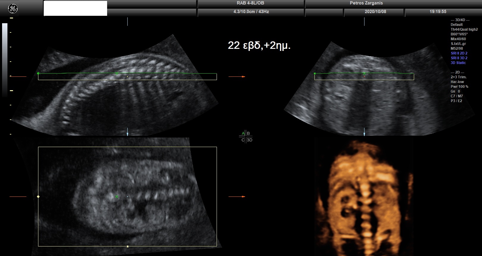 Εμβρυο 22+2 εβδομάδων . Εμφανίζεται διάταση στον αριστερό νεφρό .