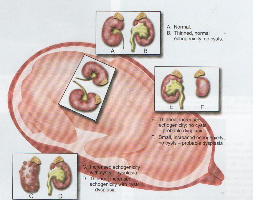 Παθοφυσιολογία εμβρυϊκής νεφρικής διάτασης