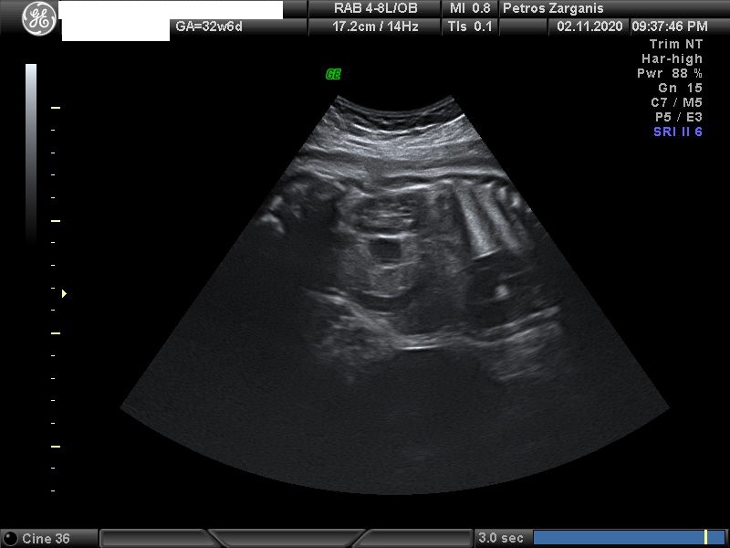 Εμβρυο 32+6 εβδομάδων , Νεφρός .