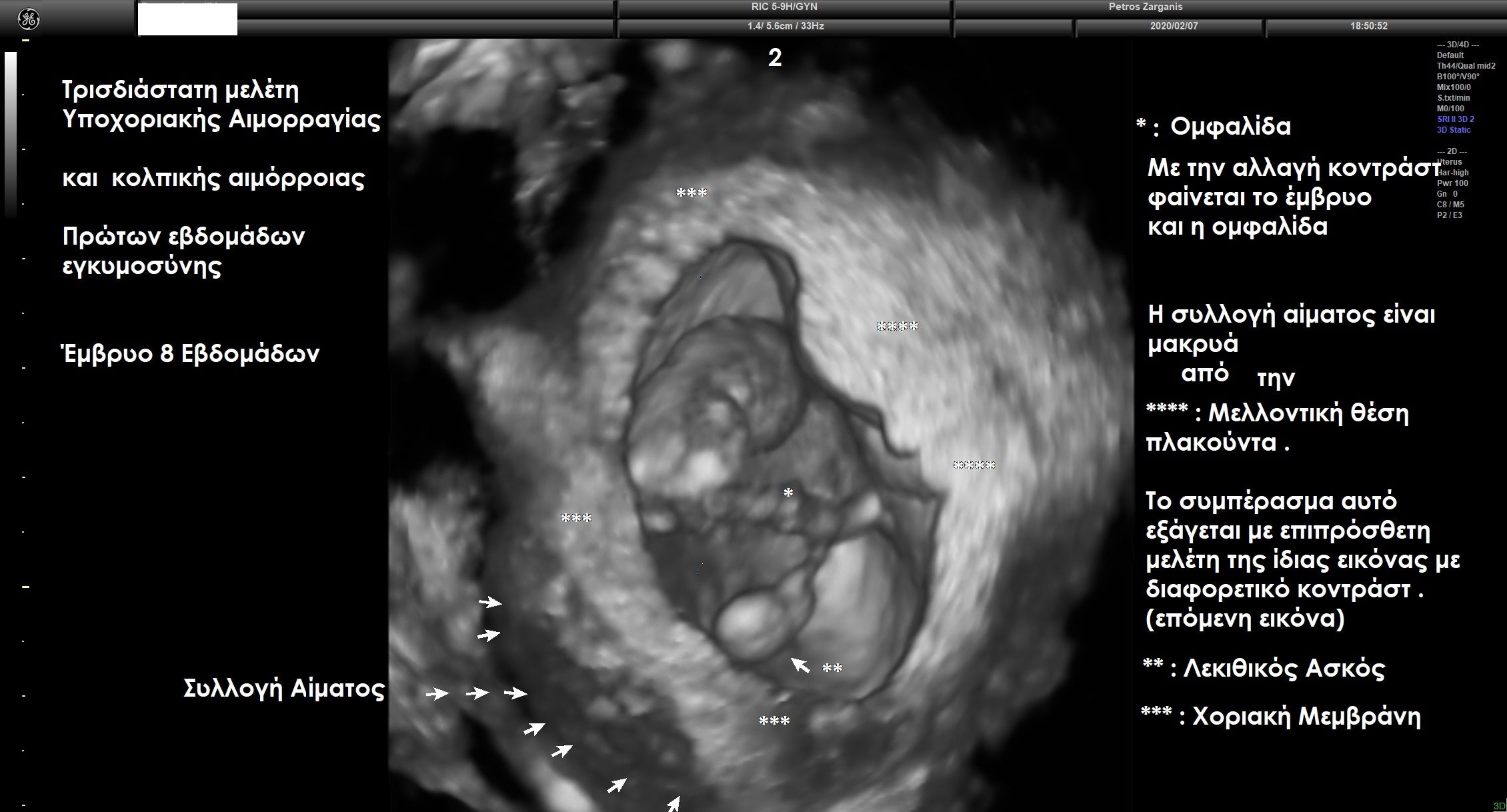 Τρισδιάστατη απεικόνιση της εγκυμοσύνης και του σάκου έτσι ώστε να γίνει καλύτερα κατανοητός ο εντοπισμός της αιμορραγίας . 
Εδώ, έχει αφαιρεθεί η απεικόνιση της αμνιακής μεμβράνης , οπότε φαίνεται το έμβρυο και η ομφαλίδα .