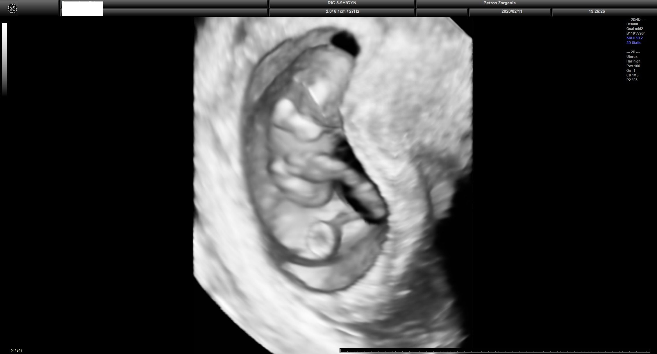Ίδια εικόνα ώστε να δούμε το έμβρυο και το λεκιθικό ασκό .