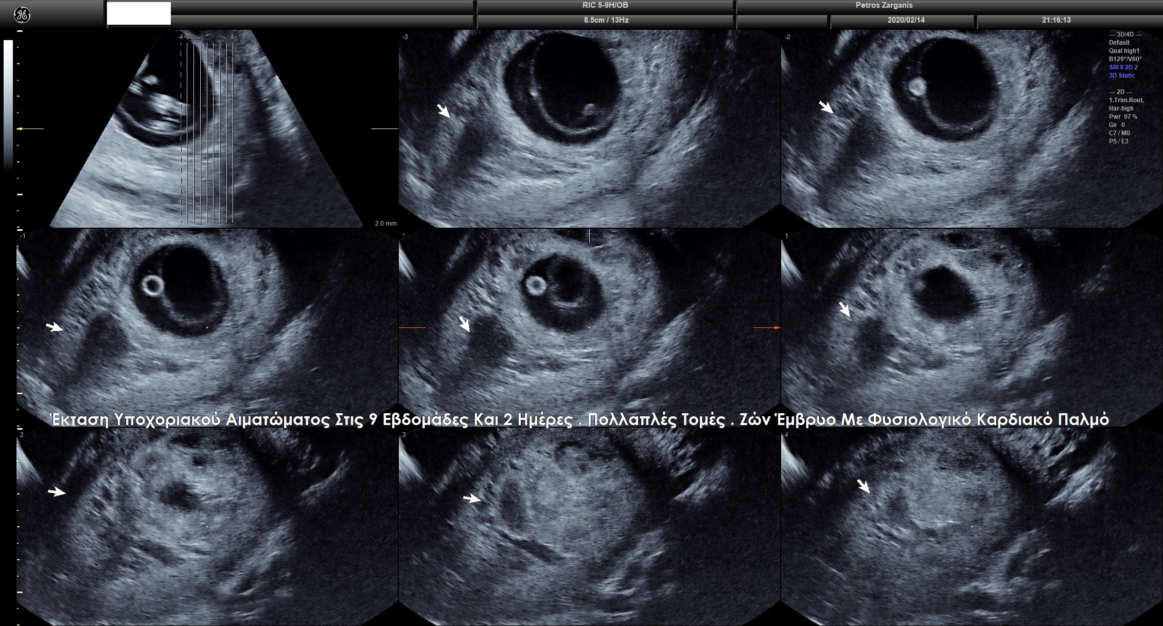 Απεικόνιση της εγκυμοσύνης στις 9 εβδομάδες και 2 ημέρες  με πολλαπλές τομές . 
Η υποχοριακή αιμορραγία φαίνεται στα βέλη .
