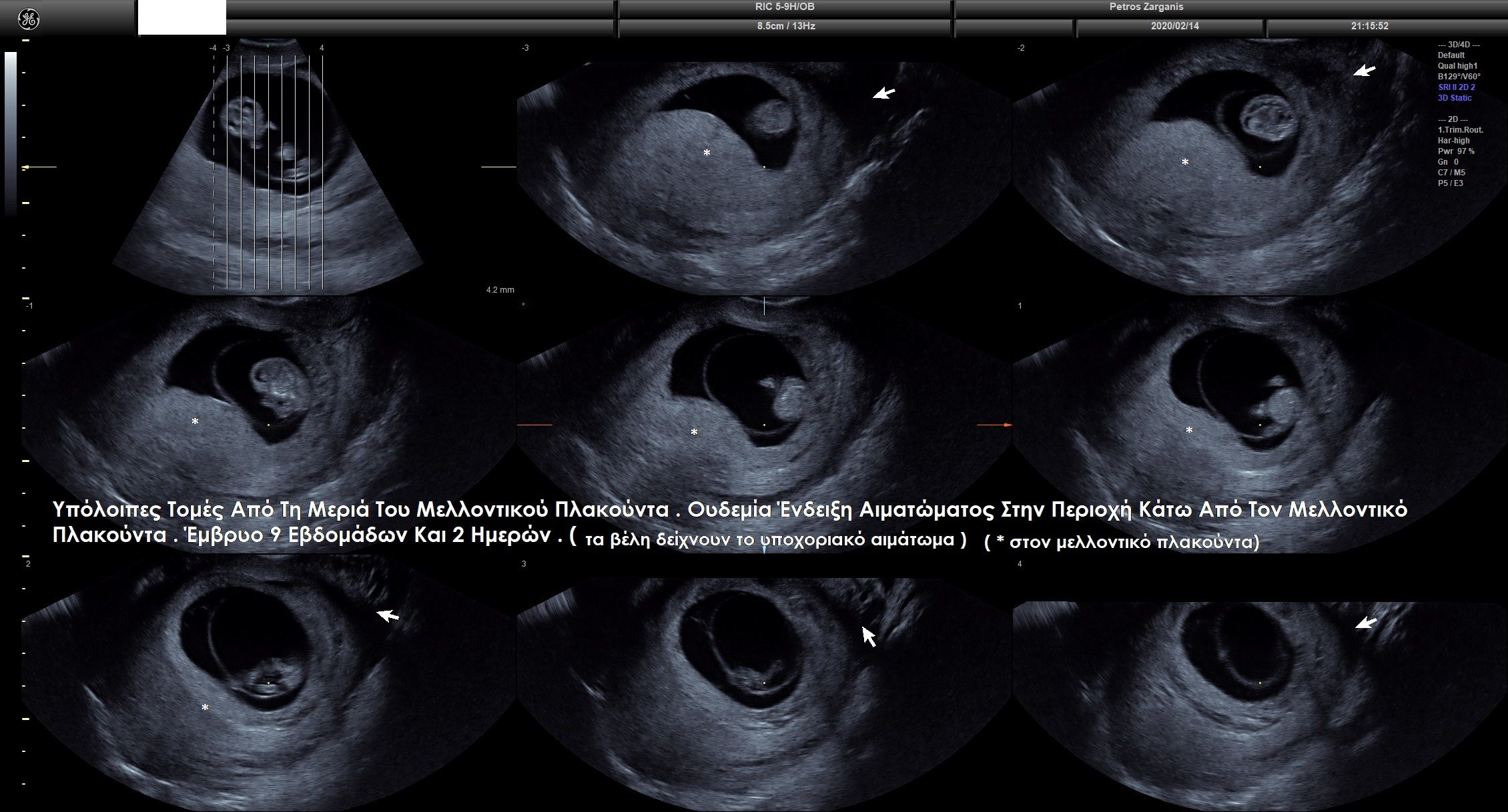 Απεικόνιση της εγκυμοσύνης στις 9 εβδομάδες και 2 ημέρες  με πολλαπλές τομές . 
Η υποχοριακή αιμορραγία φαίνεται στα βέλη . [2]