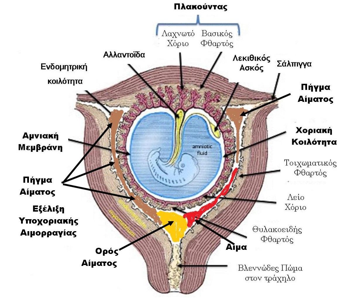 Εξέλιξη Υποχοριακής Αιμορραγίας : Έμβρυο 5-6-7-8 εβδομάδων με τις συνοδές δομές