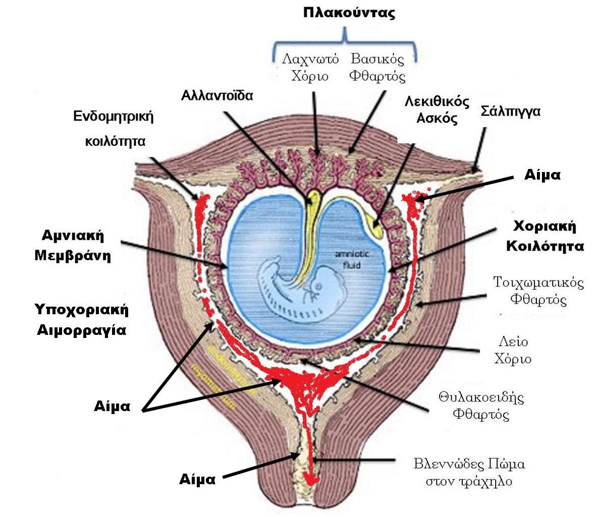 Υποχοριακή Αιμορραγία : Έμβρυο 5-6-7-8 εβδομάδων με τις συνοδές δομές