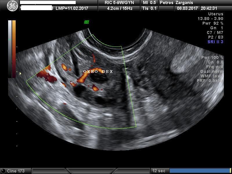 3D : Εμβρυο 11 Εβδομάδων .
