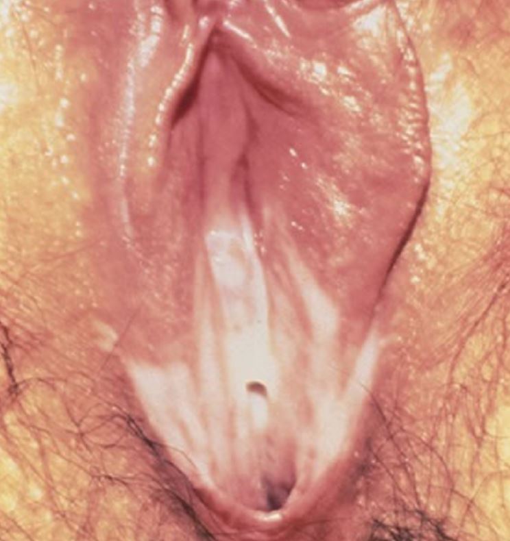 Βακτηρική Κολπίτιδα Από Αιμόφιλο Κόλπου , Gardnerella Vaginalis