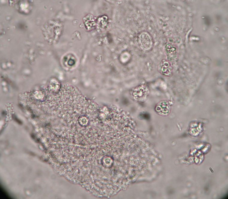 Βακτηρική Κολπίτιδα Από Αιμόφιλο Κόλπου , Gardnerella Vaginalis